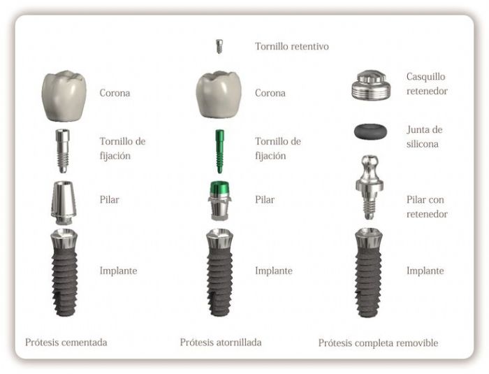 Implante Dental 3.2mm - Top Implants