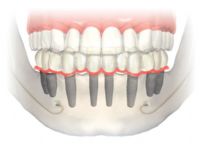 Accesorios para implantes, etc... - Top Implants
