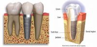 Implante dental 4.2mm - Top Implants